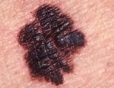 Рак родинки