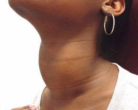 Симптомы рака щитовидной железы у женщин