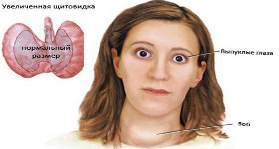 Рак щитовидной железы: симптомы у женщин