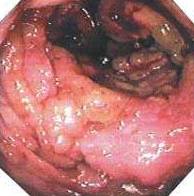 Рак слепой кишки - прогноз