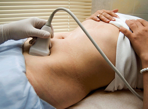 Рак яичников после родов (беременности)