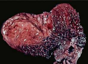 Рак желудка: симптомы, сколько живут?