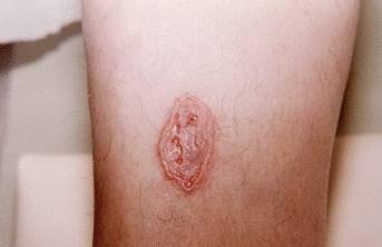 Бляшки на коже как признак рака