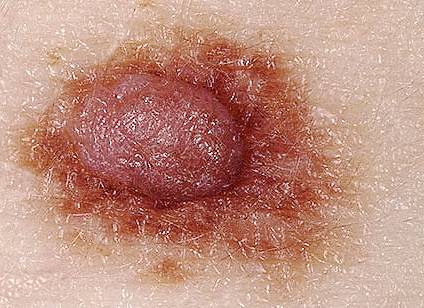 растет родинка