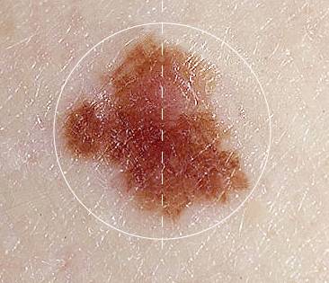 растет родинка