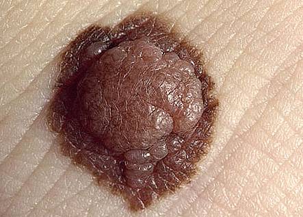 растет родинка - что делать?