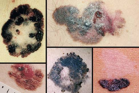 растет родинка