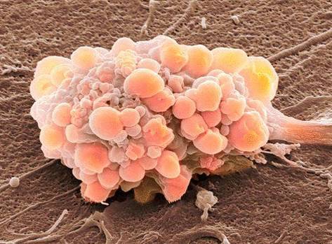 Развитие рака: как и с чего начинается развитие онкологии?