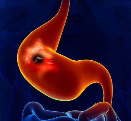 recidiv raka zheludka