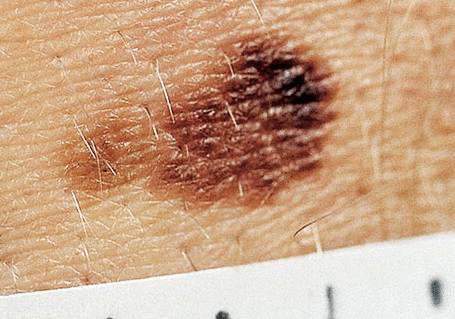 родинка начала расти