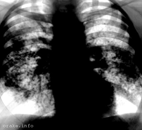 sarkoidoz legkix - lechenie
