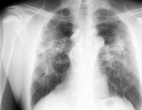 sarkoidoz-legkix-na-rentgene