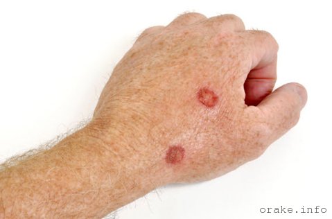 саркома кожи