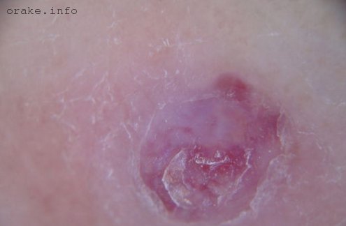 саркома кожи