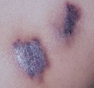 Саркома - лечение