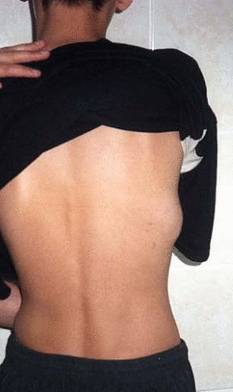 Лечение саркомы