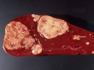 skolko zhivut s metastazami v pecheni