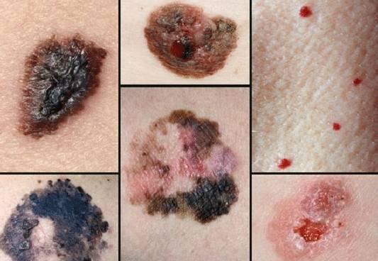 Стадии меланомы - фото, лечение, прогноз