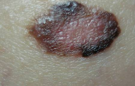 Стадии меланомы - фото, лечение, прогноз