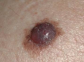 Стадии меланомы - фото, лечение, прогноз