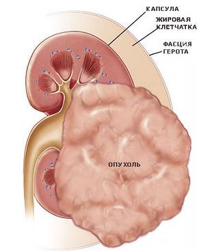 Стадии рака почки