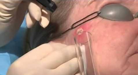 udalenie-bazaliomy-lazerom