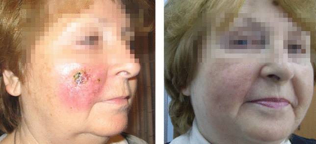 Удаление базалиомы