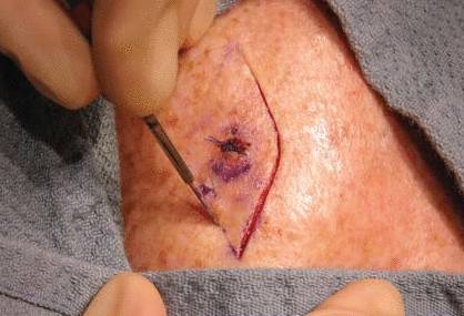 Удаление базалиомы