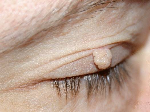 Удаление фибромы без последствий