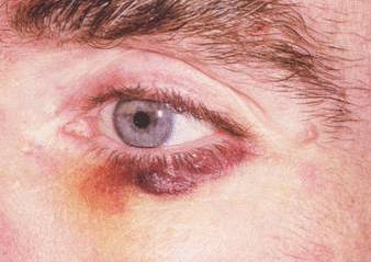 Веко новообразования