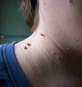 висячие родинки на шее