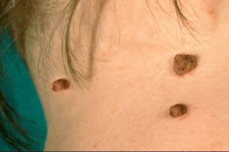 висячие родинки