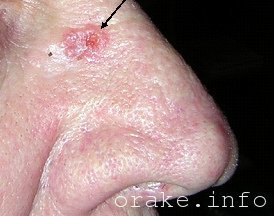 watermarked - rak kozhi nosa