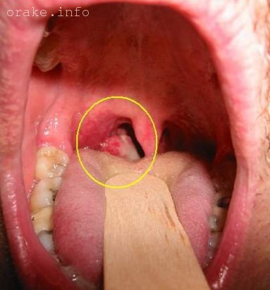 опухоли носоглотки