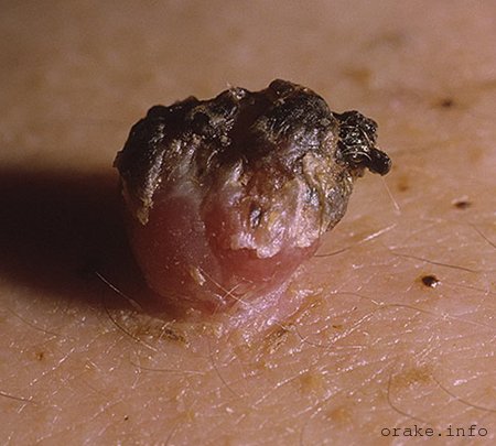 злокачественная папиллома