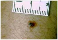 Злокачественные родинки: фото и описание