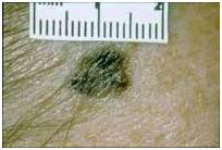 Злокачественные родинки: фото и описание