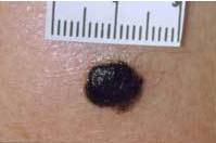 Злокачественные родинки: фото и описание