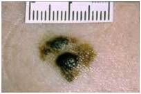 Злокачественные родинки: фото и описание