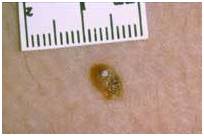 Злокачественные родинки: фото и описание