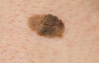 Злокачественные родинки: фото и описание