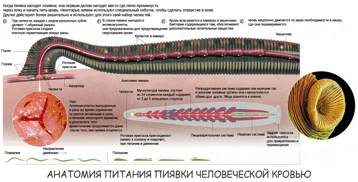 Как лечится варикозное расширение вен пиявками