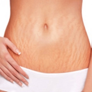 Avent крем от растяжек