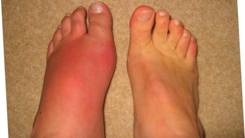 Что делать, если опухают суставы на ногах