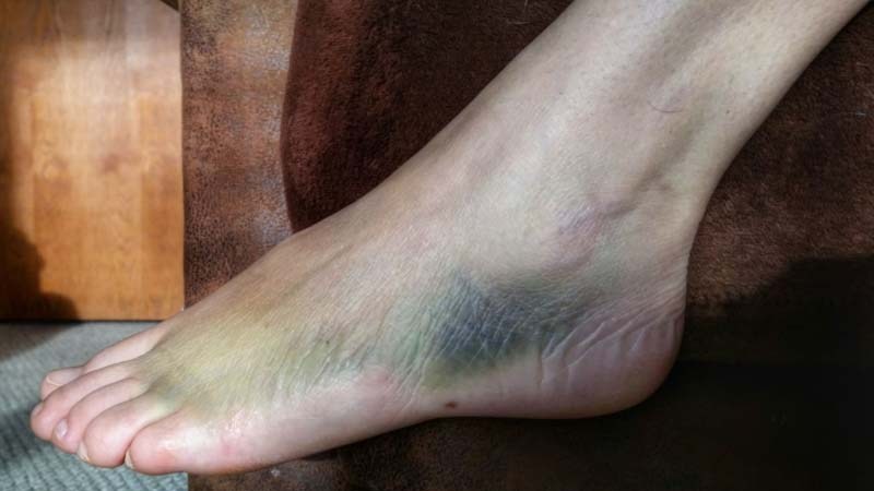 Что делать при вывихе голеностопного сустава