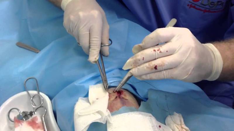 Разрыв передней крестообразной связки (ПКС) колена