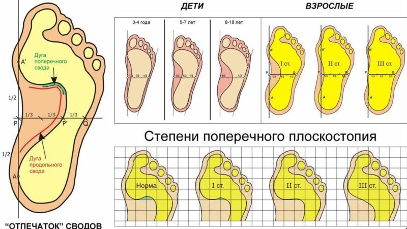 Что такое плантограмма стопы и как её делают