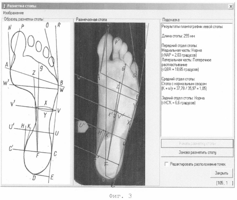 Что такое плантограмма стопы и как её делают