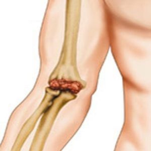 Что такое сустав: строение и функции