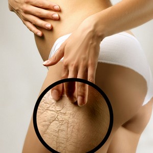 Двойное действие крема Мустела от растяжек